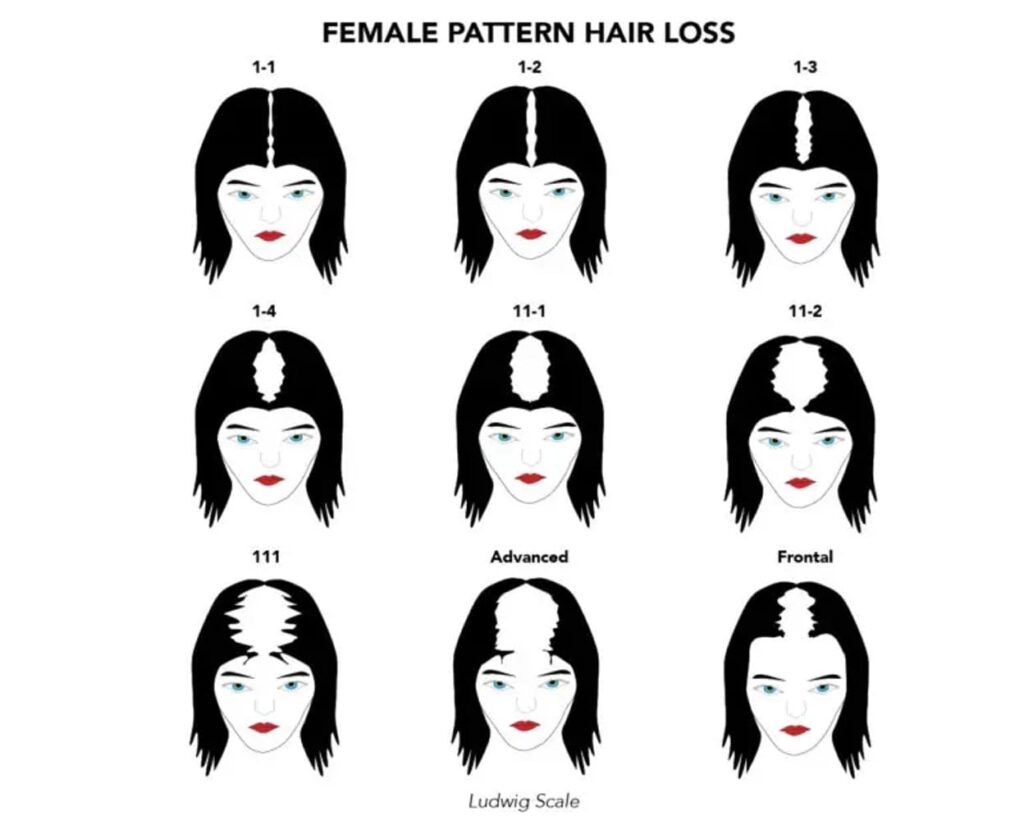 ink+art female pattern hairloss 